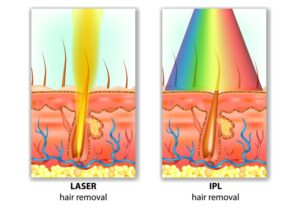 epilation lumiere pulsee laser